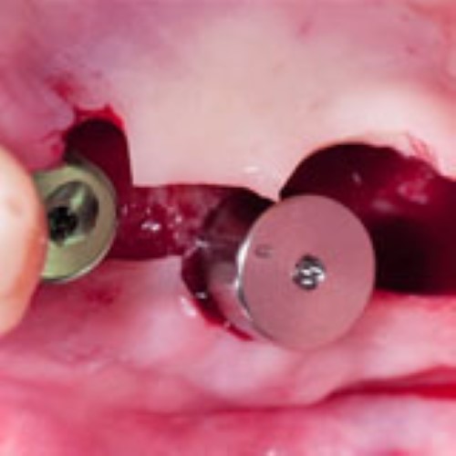 Implant uncoverage in functional areas - clinical examples